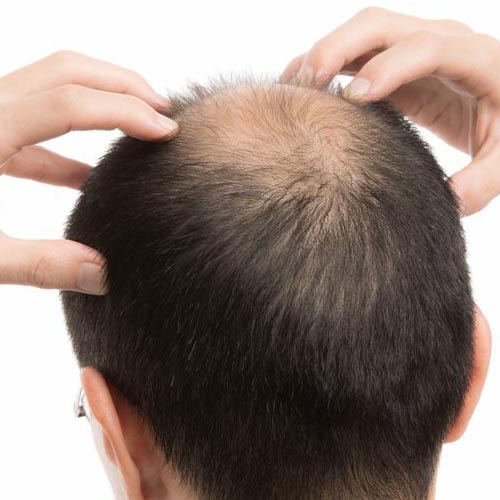 выпадение волос у мужчин, почему выпадают волосы у мужчин в молодом возрасте, плазмотерапия волос для мужчин, плазмолифтинг волос для мужчин отзывы, плазмолифтинг волос для мужчин, перхоть на бровях у мужчин лечение, перхоть на бровях у мужчин, мезотерапия для волос отзывы мужчин, мезотерапия волос отзывы мужчин, мезотерапия волос для мужчин до и после, выпадение волос у мужчин психосоматика, выпадение волос у мужчин причины и лечение, выпадение волос у мужчин причины, выпадение волос у мужчин лечение народными средствами, выпадение волос у мужчин лечение, выпадение волос у мужчин кругами, выпадение волос у мужчин к какому врачу обратиться, выпадение волос у мужчин витамины