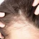 Психосоматика выпадения волос