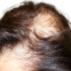 психосоматика выпадения волос у детей