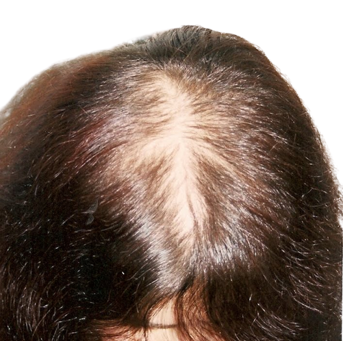 психосоматика выпадения волос