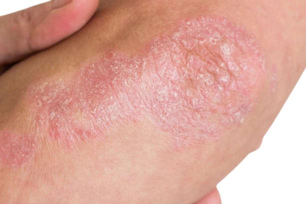 A-Z_psoriasis-2_