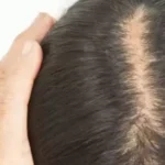 менопауза и волосы