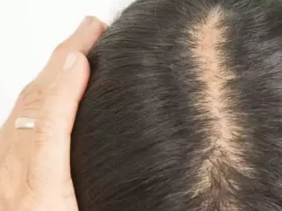 менопауза и волосы