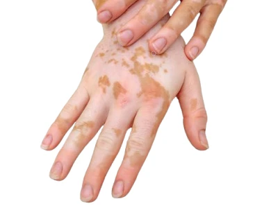 Нарушения пигментации кожи